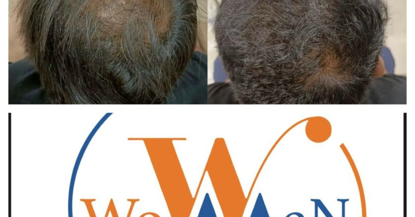 “WowMen Clinic: 10+ Years & 4500+ Satisfied Clients, A Leader in Sustainable Cosmetic Treatments!”
