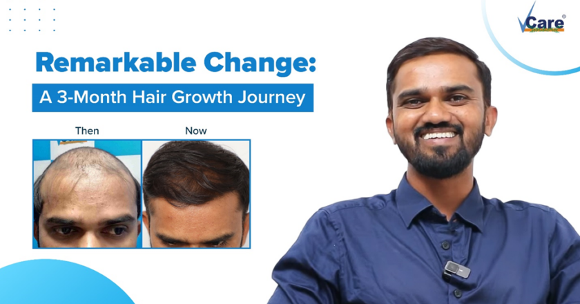 Unlock Your Confidence with VCare’s Revolutionary Hair Regrowth Solution!