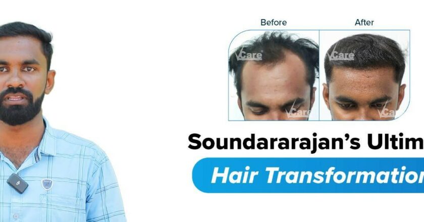 REVERSING BALDNESS WITH VCARE 