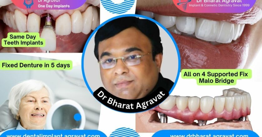 Best Dentist for Full Mouth Dental Implants Clinic in Ahmedabad: Dr. Bharat Agravat, the  top Implantologist.