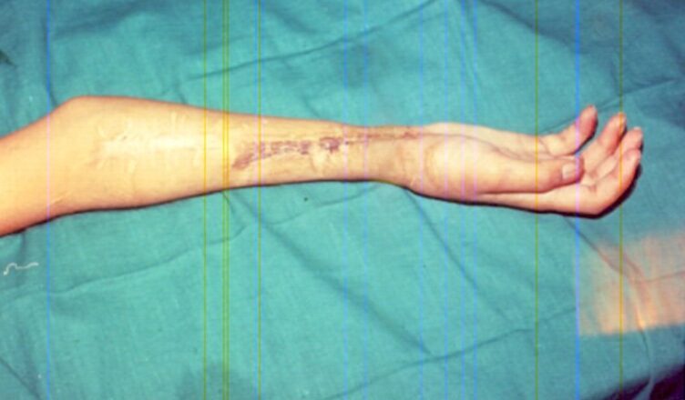 Real-life story: Reconstruction of hand and dramatic recovery