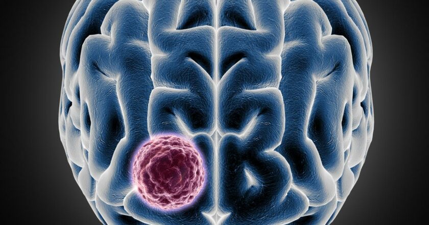 Sakra successfully conducts a landmark surgery for 10*9 cm giant meningiomaon a 34-year-old  international patient from Ghana