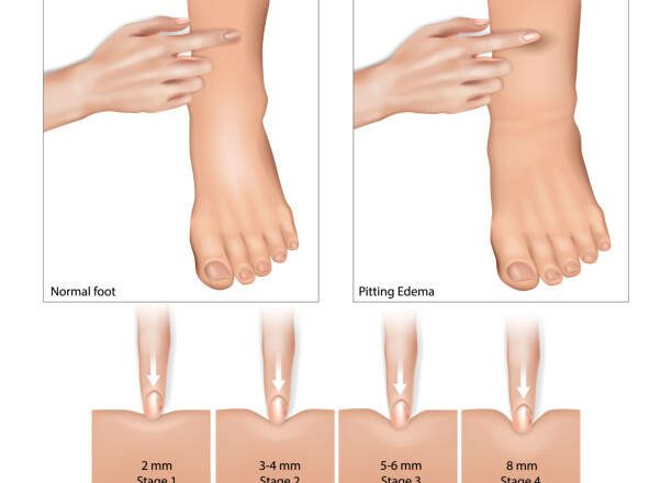 What is the most common cause of fluid retention and how it affects your blood pressure?