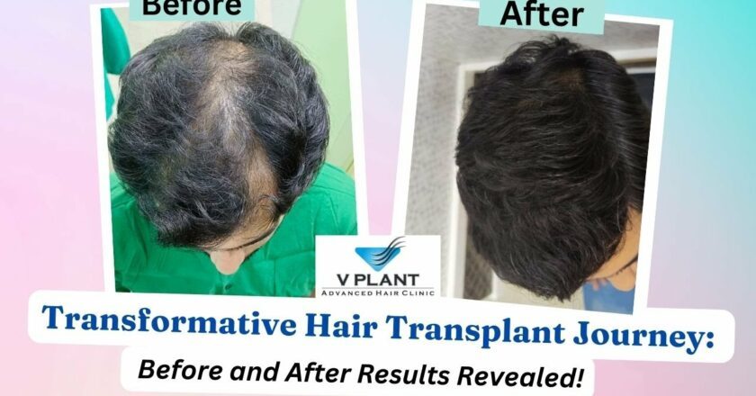 Vplant Hair Clinic Mumbai Introduces Advanced MHI Hair Transplant Technique for Painless, Scar-Free Results