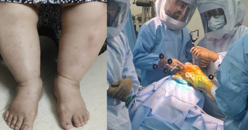 From 140 KGs and Years of Knee Pain to Walking Freely: Dr. Saikat Jena Restores a Woman’s Life with Surgery